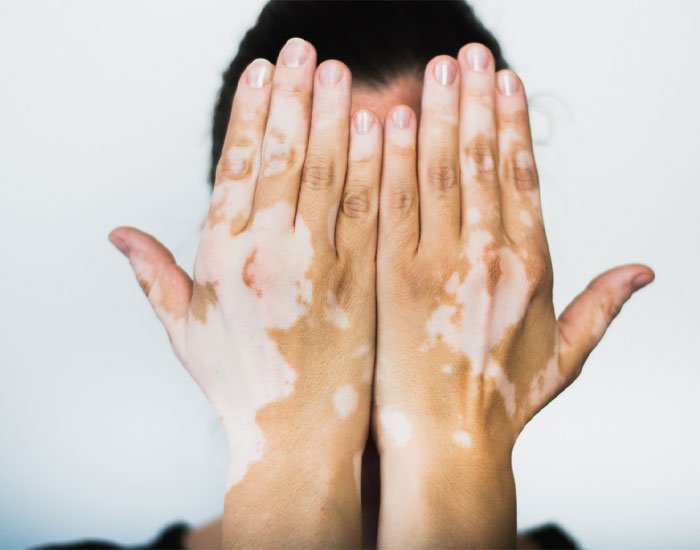 Ala Hastalığı Nasıl Geçer