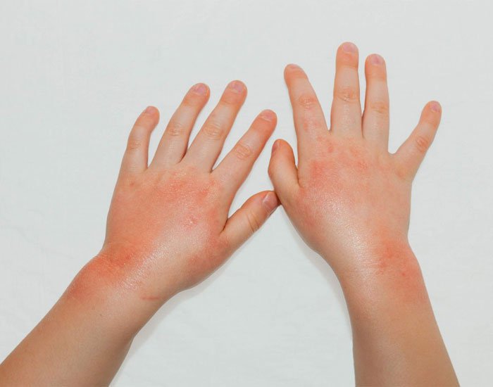 Alerjik Ve Kuru Egzama Tedavisi