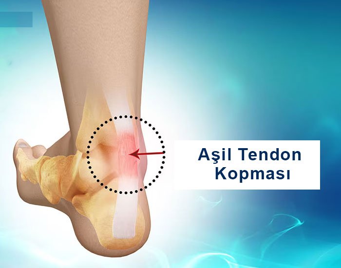 Aşil Tendonu Yırtılması Belirtileri