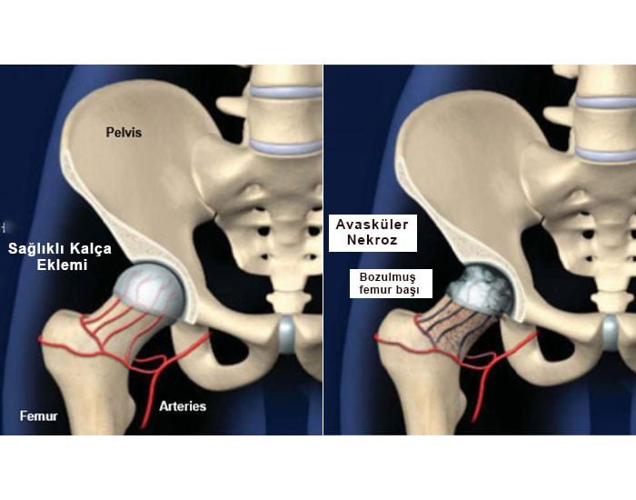 Avasküler Nekroz Nedenleri Ve Ağrısı