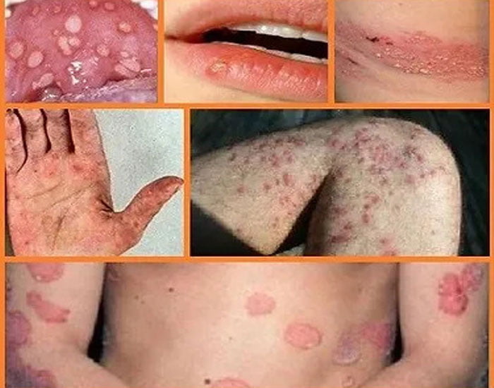 Behçet Hastalığı Belirtileri Ve Nedenleri Bulanık Görme