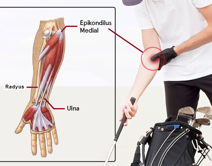Beyzbol Dirseği Tedavisi Konya