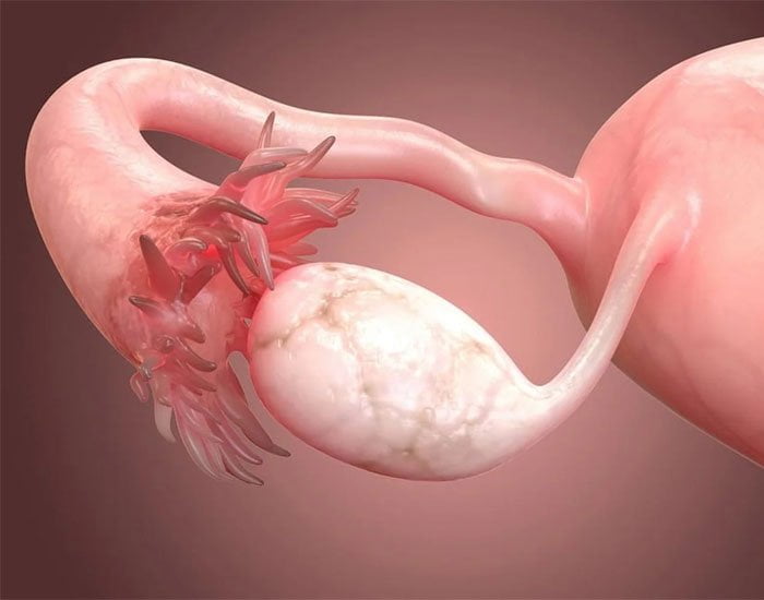 Bitkisel Polikistik Over Tedavisi Konya