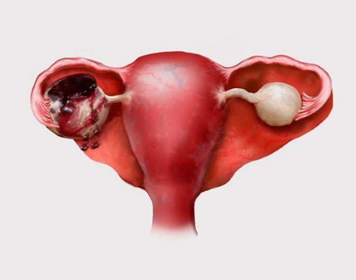 Çikolata Kisti Tedavisi Konya