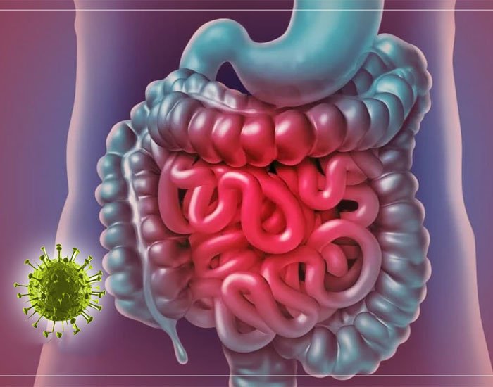 Crohn Hastalığı Nedeni