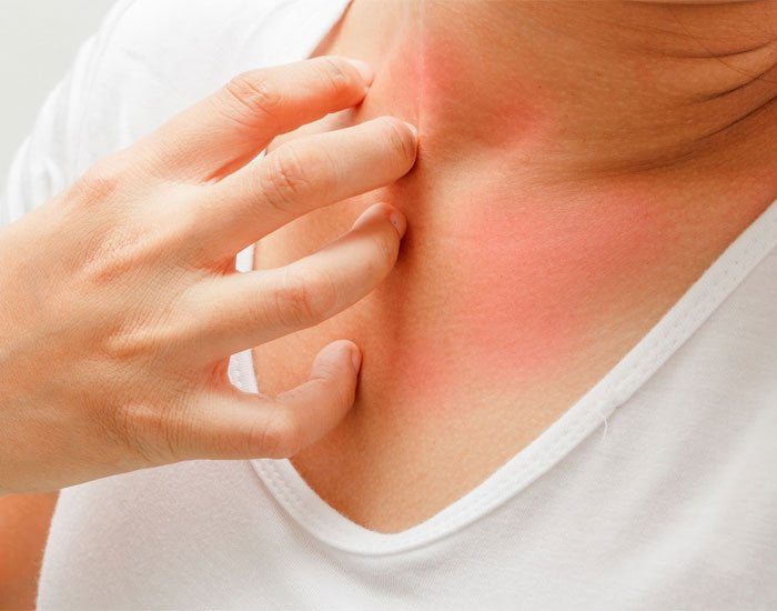 Egzama Hastalığı Tedavisi ve Egzama Belirtileri Neden Olur