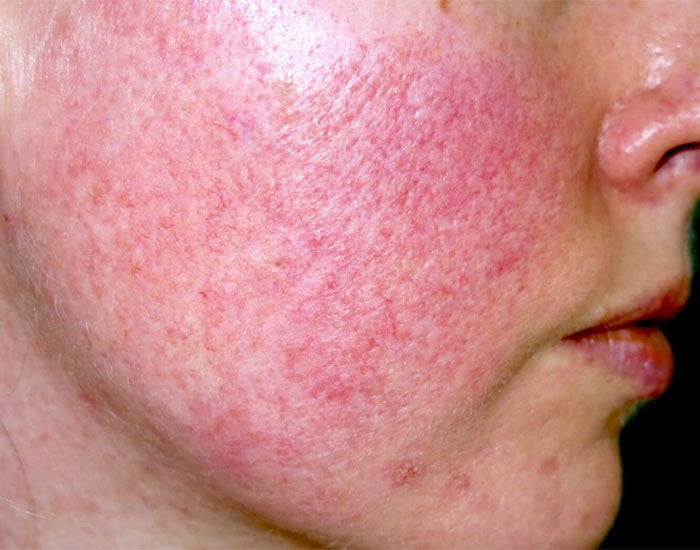 Gül Hastalığı Pityriasis Rosea Konya Doktorları