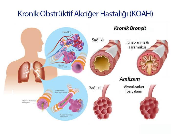 Konya KOAH Kronik Obsrüktif Akciğer Hastalığı Tedavisi