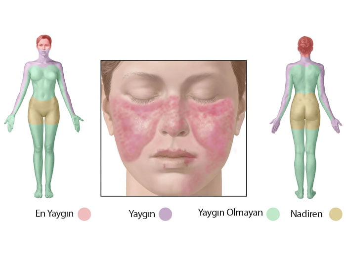 Konya Kelebek Hastalığı (Lupus) Doktorları