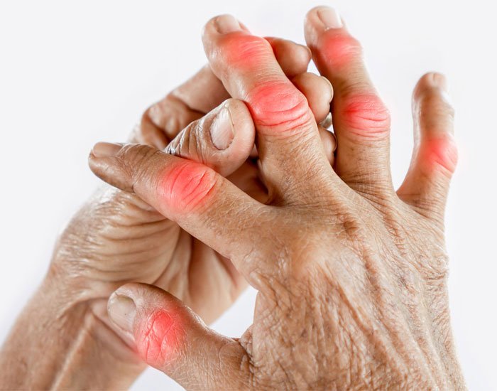 Konya Sedef Hastalığı Kesin Tedavi