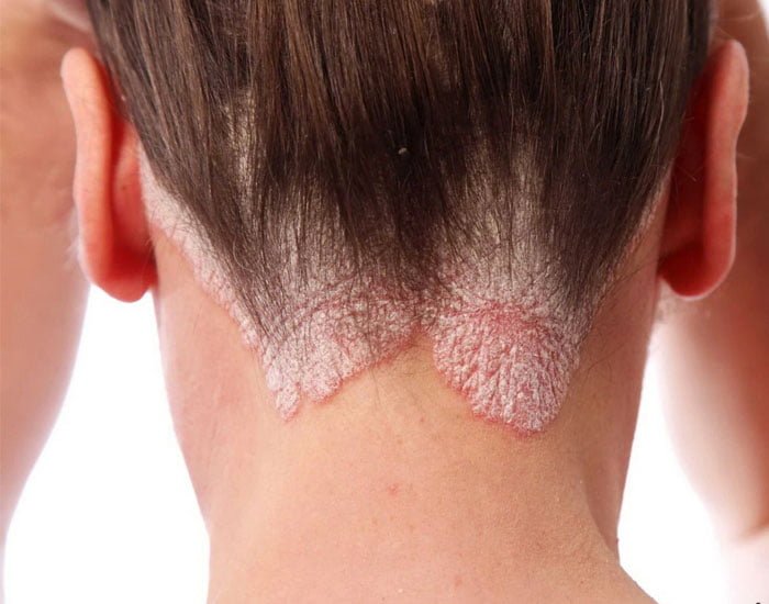 Konya Sedef Hastalığı Kesin Tedavisi