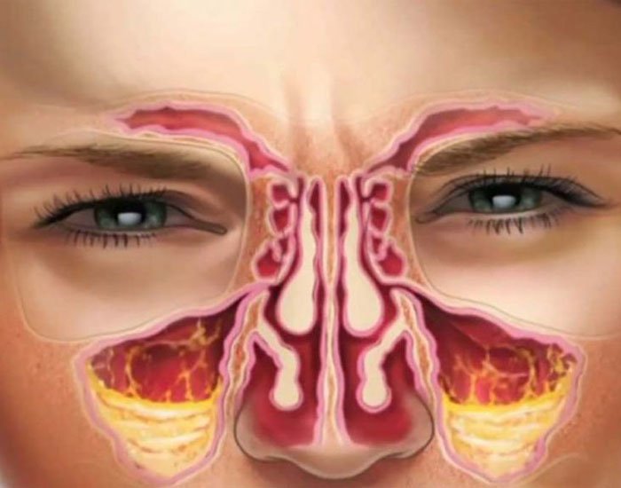 Sinüzit Belirtileri ve Tedavisi Konya - Dr Necmettin Tüfekci