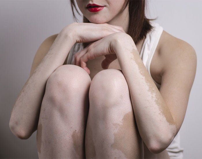 Konya Vitiligo Tedavisinde En İyi Doktor