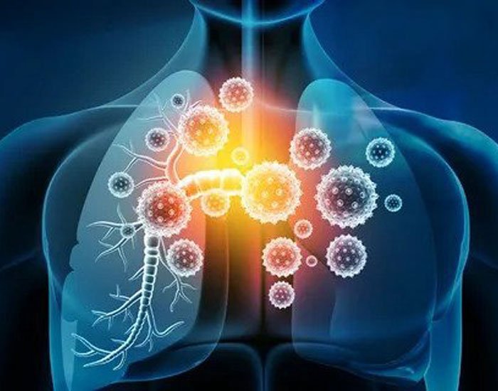 Kronik Bronşit Tedavisinde Kullanılan İlaçlar