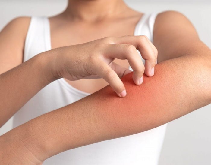 Kurdeşen Hastalığı Tedavisi Bitkilerde Tedavi