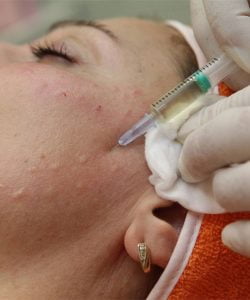 Mezoterapi Yüze Ve Cilde Faydaları