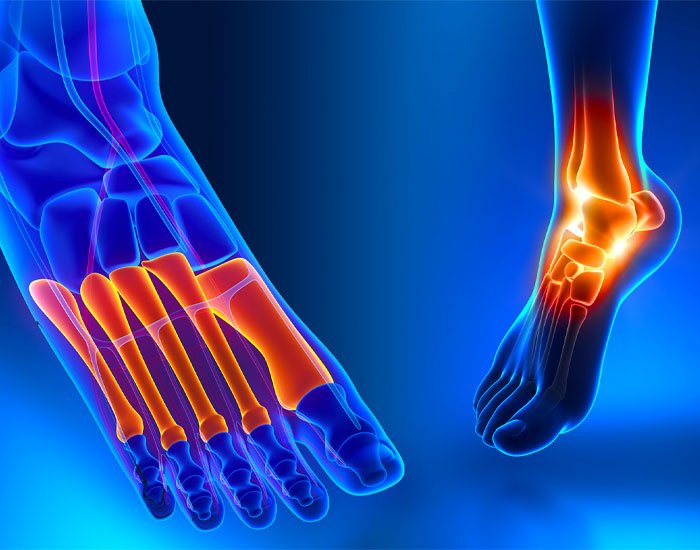 Periferik Nöropati Ağrısı Nasıl Geçer