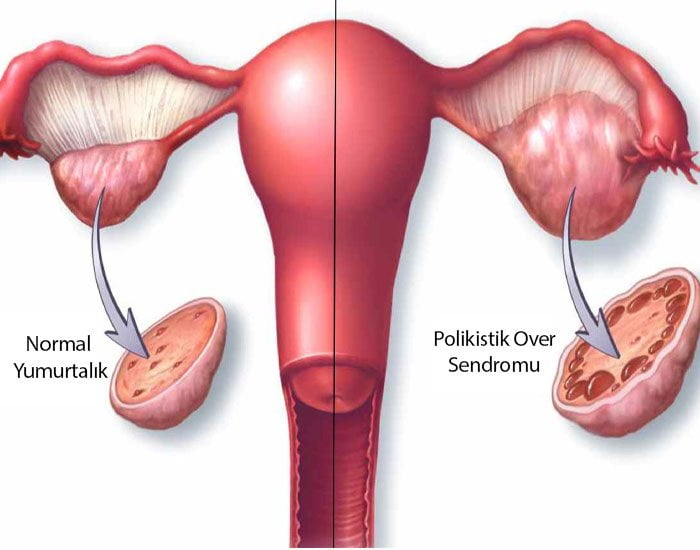 Polikistik Over Sendromu Nedir Nasıl Geçer