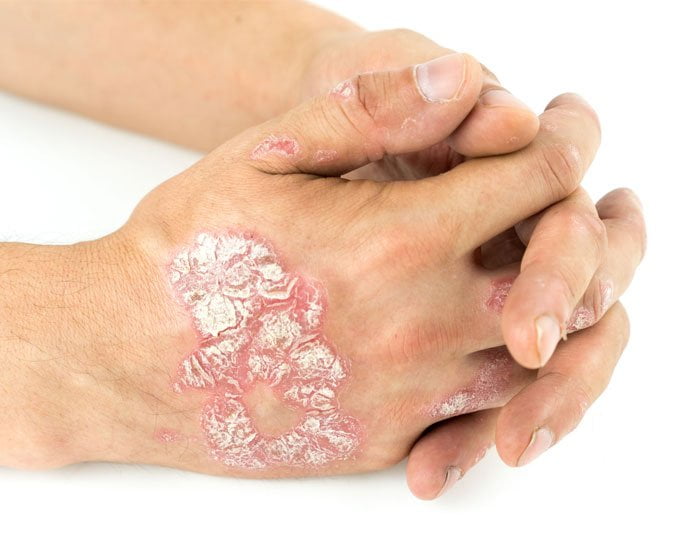 Sedef Hastalığı Belirtileri Neden Olur Nasıl Geçr