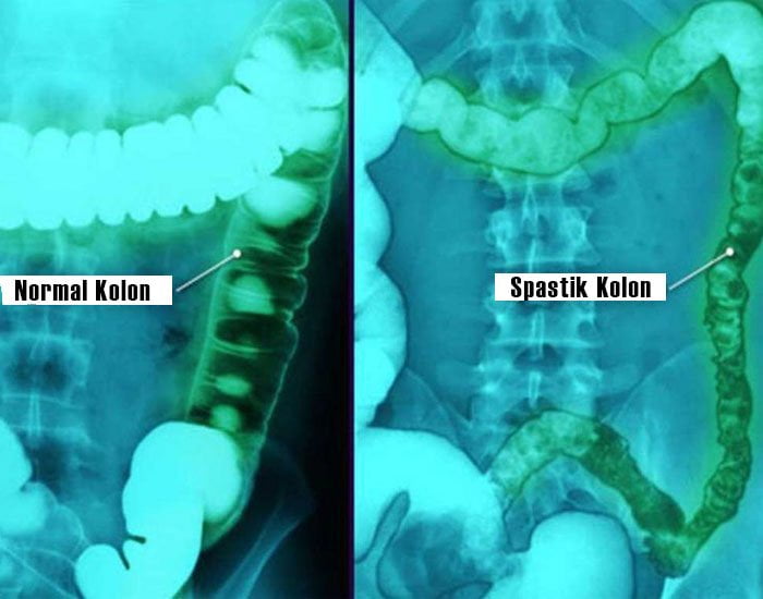 Spastik Kolon Ne İyi Gelir