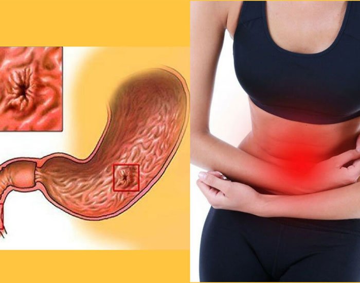 Stres Ve Mide Ülseri Belirtileri