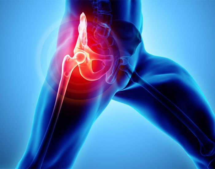 Avasküler Nekrozu Kanser Tedavisi Ve Femur Başı Avasküler Nekrozu Bitkisel Tedavi