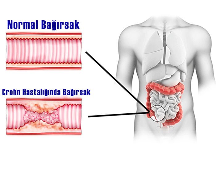 Crohn Hastalığı Tedavisi Konya