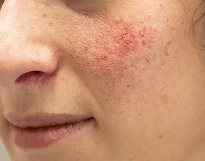 Gül Hastalığı Lazer Tedavisi Konya