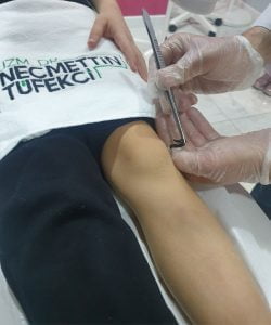 Hirudoterapi Nedir Nasıl Yapılır