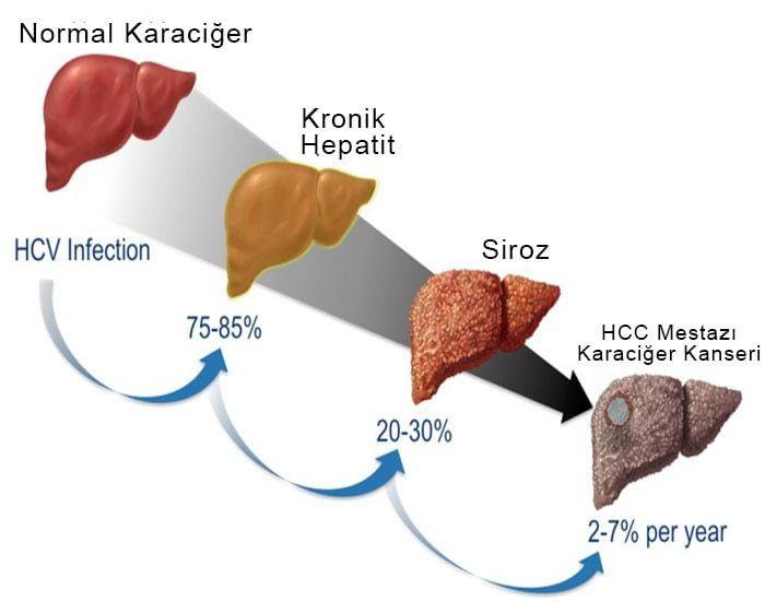 Kronik Hepatit A, B Ve C Tedavisi Konya
