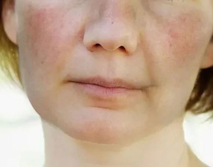 Lupus Kelebek Hastalığı Tedavisi Konya