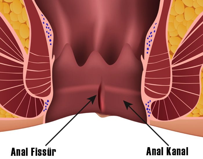 Makat Çatlaüı Tedavisi Konya Uzman Doktor