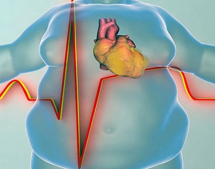 Metabolik Sendrom Hastalıkları Belirtileri ve Tedavisi