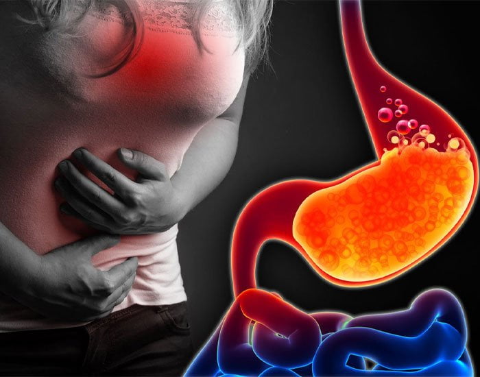 Reflü Belirtileri Ve Tedavisi Konya