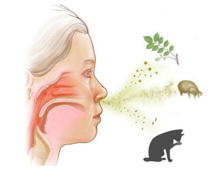 Saman Nezlesine Hangi Doktor Bakar