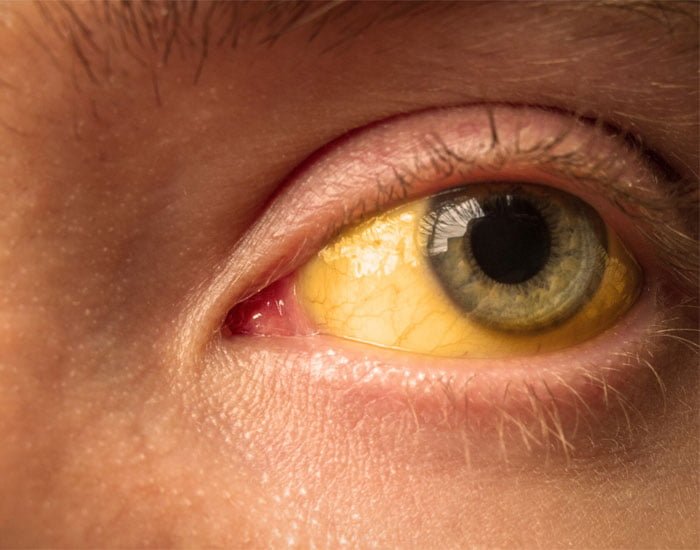 Sarılık Tedavisi Bebek Ve Yetişkin Konya