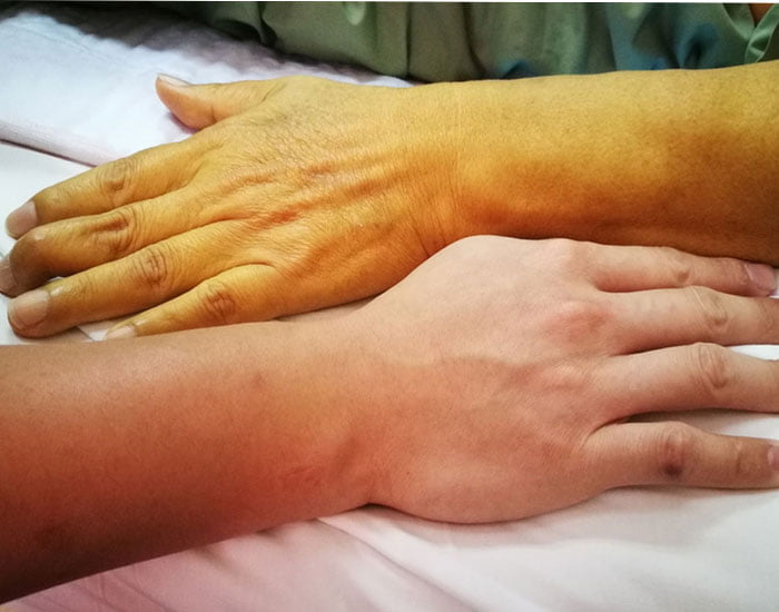 Sarılık Tedavisi Bitkisel Ve Yenidoğan Alternatif Tıp