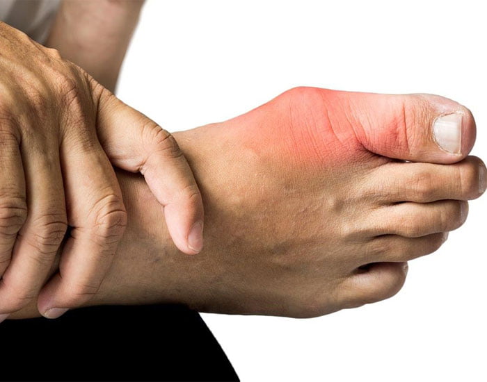 Sedef Romatizması Tedavisi