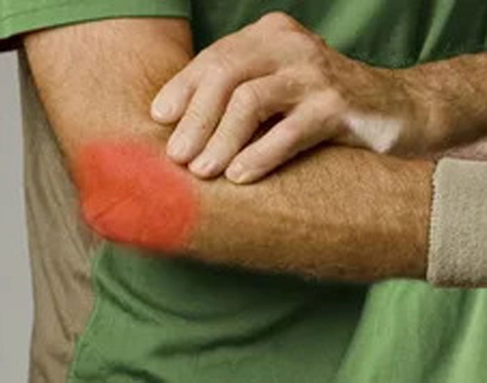 Tenisçi Dirseği Rahatsızlığı