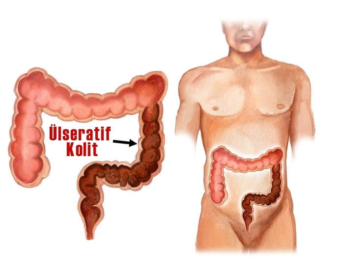 Ülseratif Kolit Tedavisi Konya Necmettin Tüfekci
