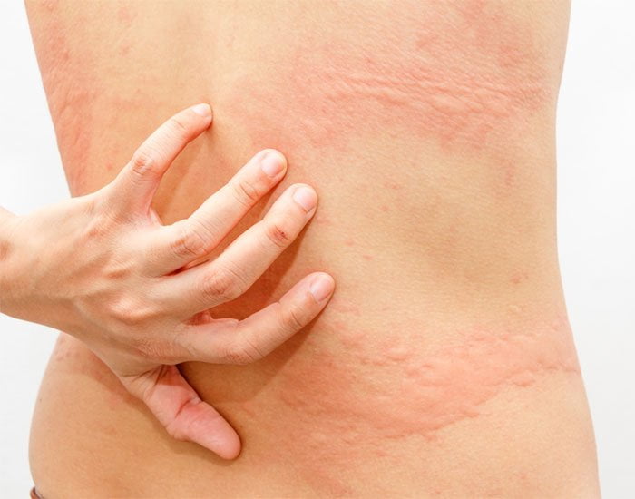 Ürtiker Bitkisel Tedavisi Konya