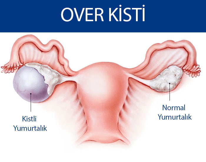 Yumurtalıklara Sülük Tedavisi